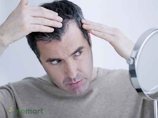 Nguyên nhân phổ biến khiến nam giới bị rụng tóc