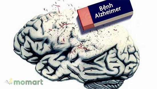 Căn bệnh Alzheimer mất trí nhớ