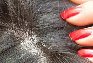 Dầu gội trị nấm ngăn ngừa rụng tóc và trị nấm hiệu quả nhất